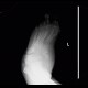 Charcot arthropathy, neuropathic osteoarthropathy, Charcot joint: X-ray - Plain radiograph